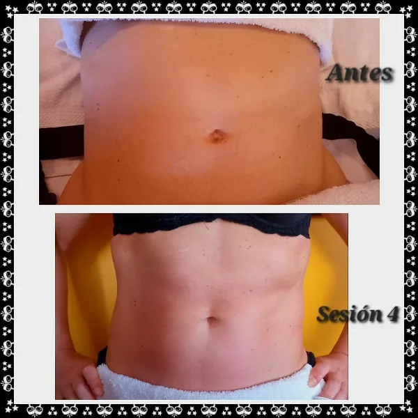 Antes y cuarta sesión de lipoescultura sin cirugía en abdomen en Bella Afrodita, Chillán