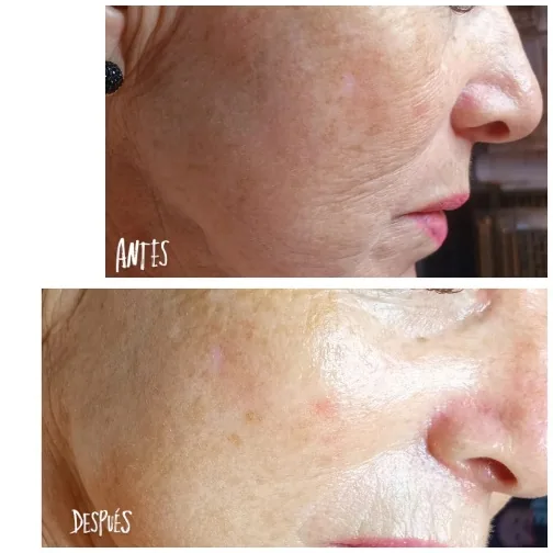 Antes y después de rejuvenecimiento facial en Bella Afrodita, Chillán: piel más firme y luminosa