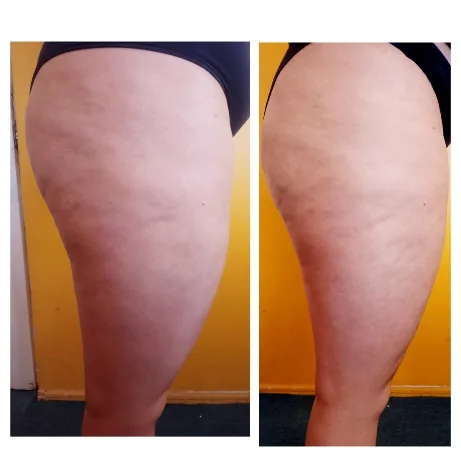Antes y después de lipoescultura sin cirugía en muslos en Bella Afrodita, Chillán