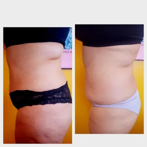 Antes y después de lipoescultura sin cirugía en abdomen y cintura en Bella Afrodita, Chillán