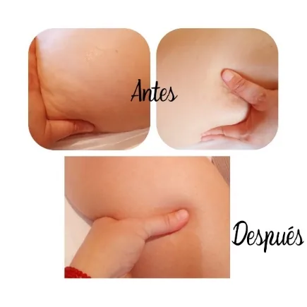 Antes y después del manejo de celulitis en Bella Afrodita, Chillán: piel más lisa y uniforme