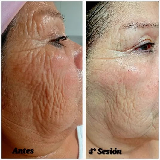 Antes y cuarta sesión de rejuvenecimiento facial en piel madura, Bella Afrodita Chillán