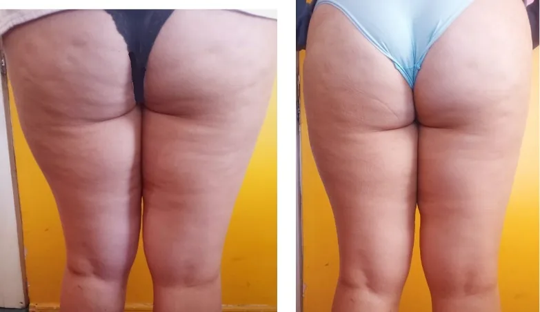 Antes y después de tratamiento reductivo en glúteos y muslos en Bella Afrodita, Chillán